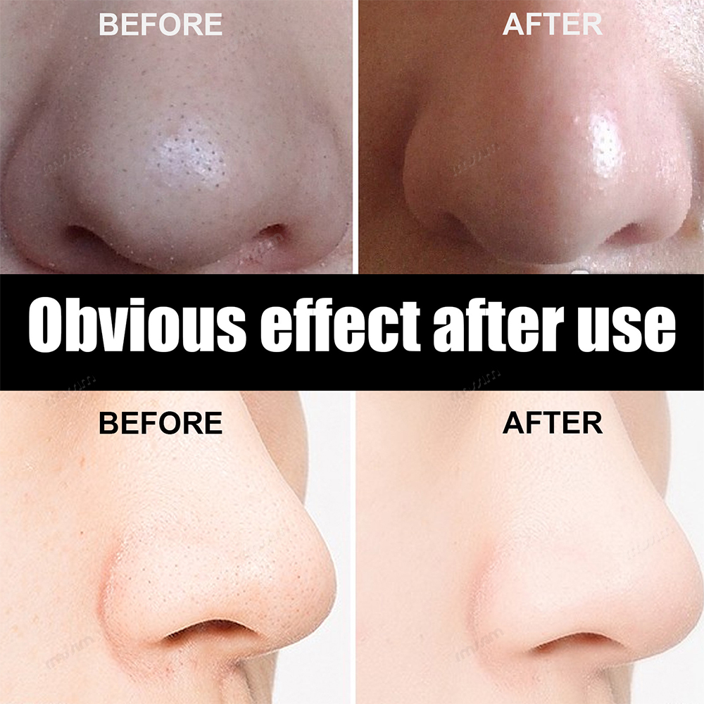 New 10-100pcs Unisex Blackhead - Skincare Viral Tiktok 리뷰 및 가격